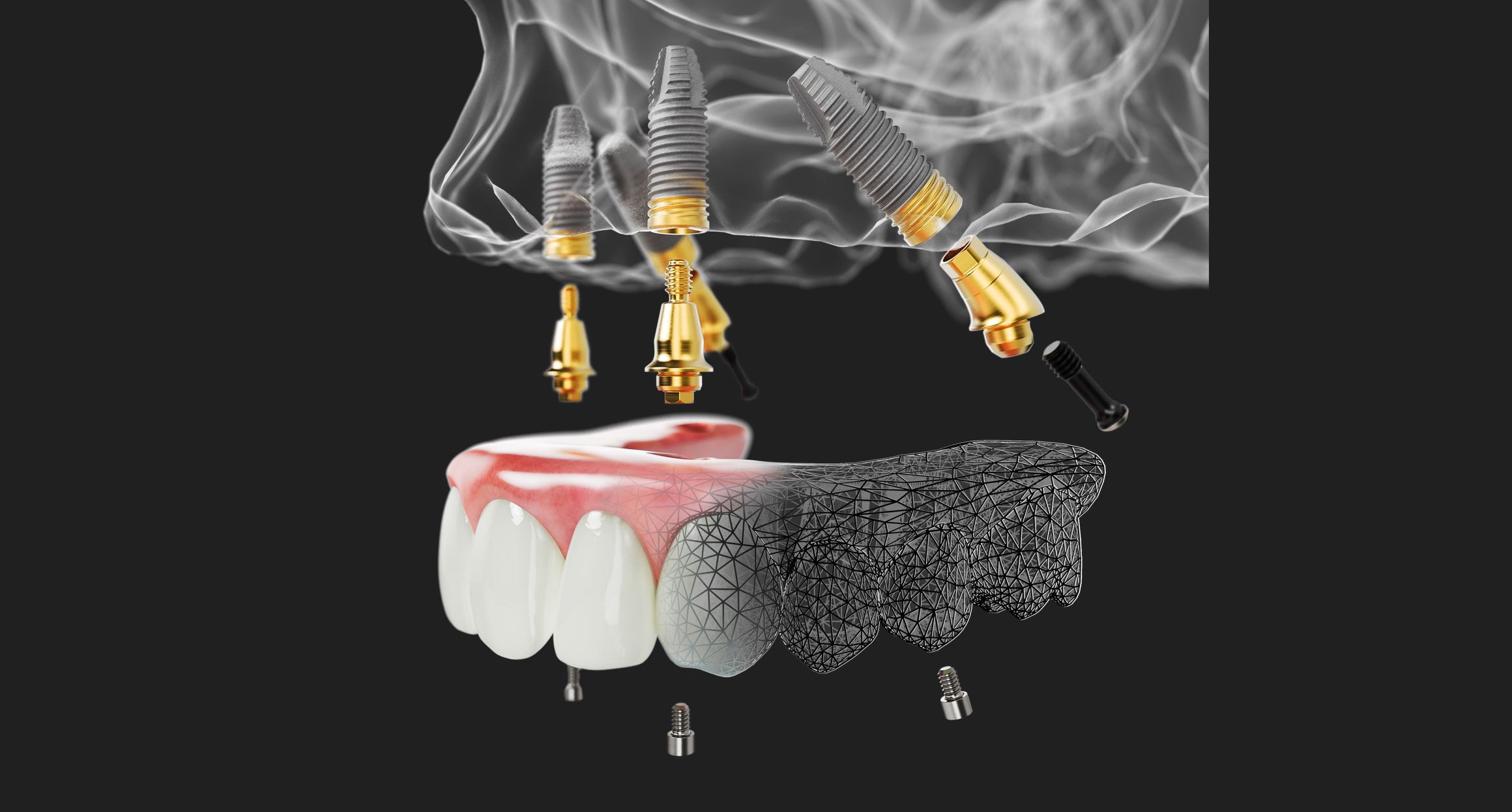 All-on-4 full-arch implant restoration diagram